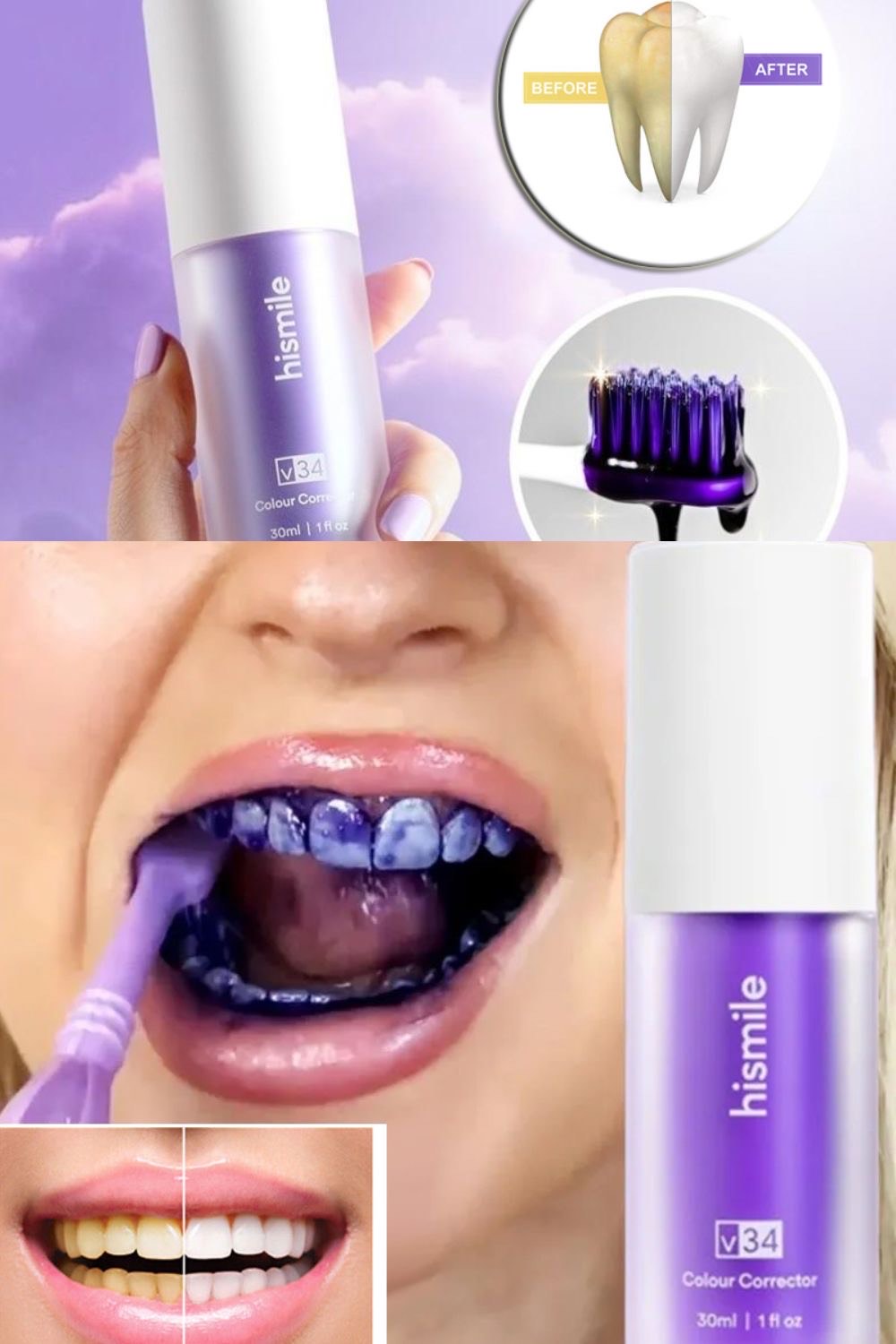 Correcteur de dent V34